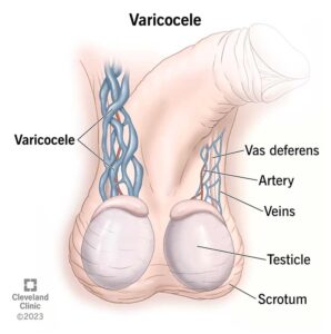 Varicocele 