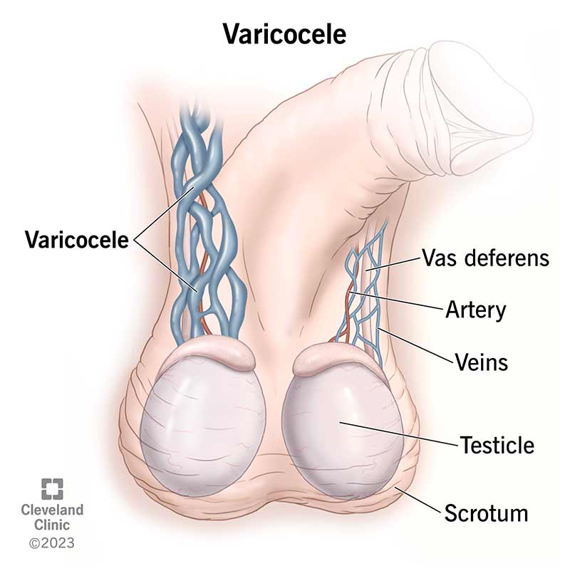 Natural Ways to Manage Varicocele: Diet & Lifestyle Tips