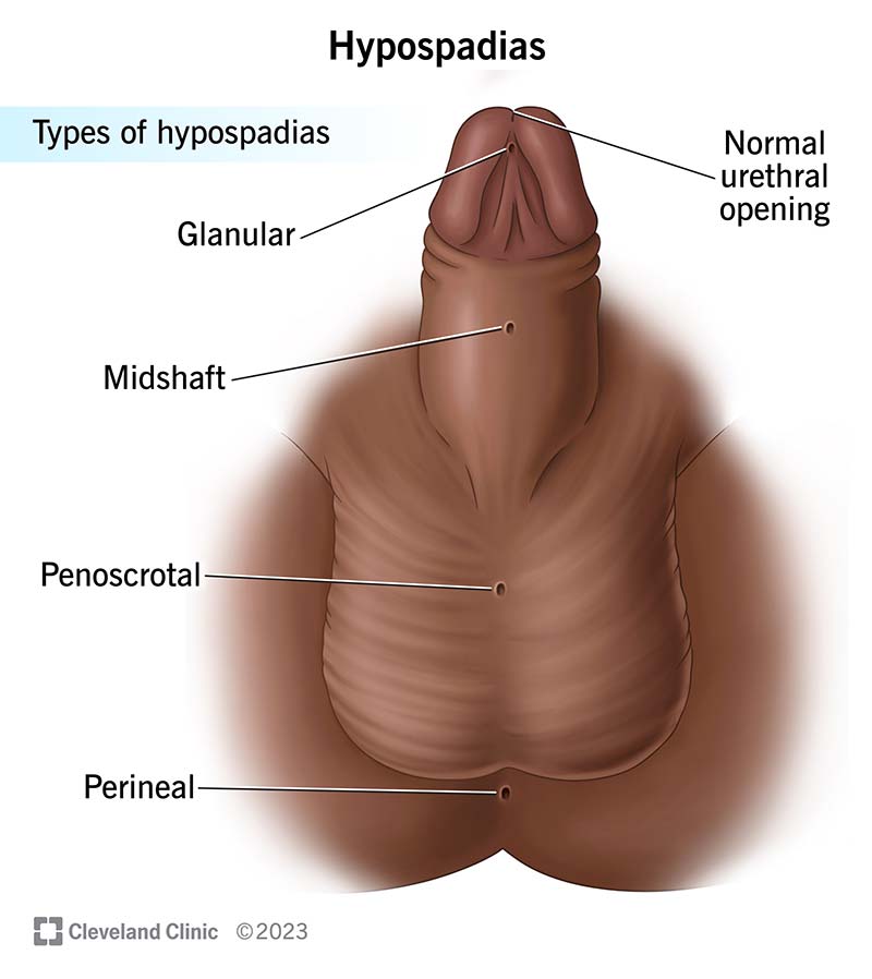 Diet Guide for Hypospadias: Surgery & Long-Term Care